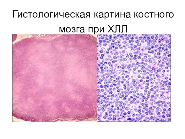 Гистологическая картина костного мозга при ХЛЛ