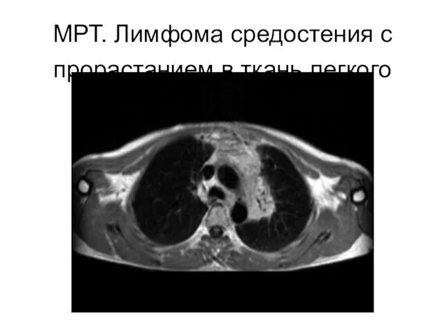 МРТ. Лимфома средостения с прорастанием в ткань легкого