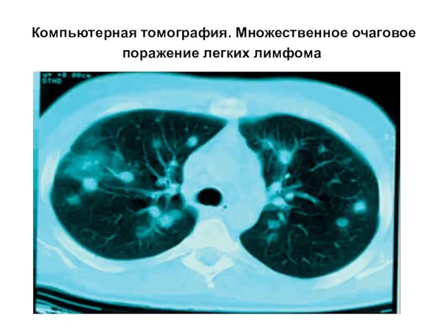 Компьютерная томография. Множественное очаговое поражение легких лимфома