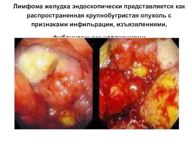 Лимфома желудка эндоскопически представляется как распространенная крупнобугристая опухоль с признаками инфильрации, изъязвлениями, фибринозными наложениями