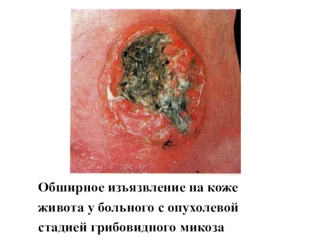 Обширное изъязвление на коже живота у больного с опухолевой стадией грибовидного микоза