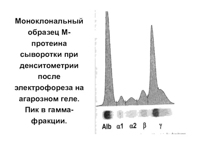 Моноклональный образец М-протеина сыворотки при денситометрии после электрофореза на агарозном геле. Пик в гамма-фракции.
