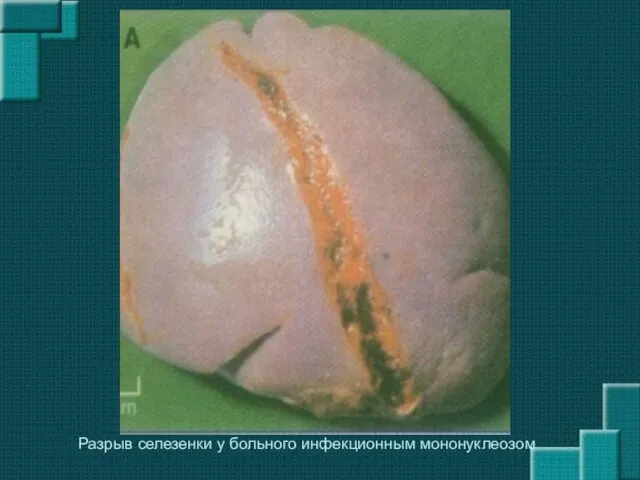 Разрыв селезенки у больного инфекционным мононуклеозом