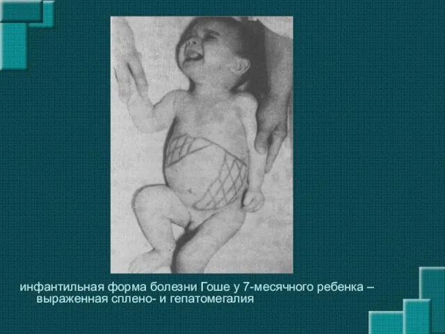 инфантильная форма болезни Гоше у 7-месячного ребенка – выраженная сплено- и гепатомегалия