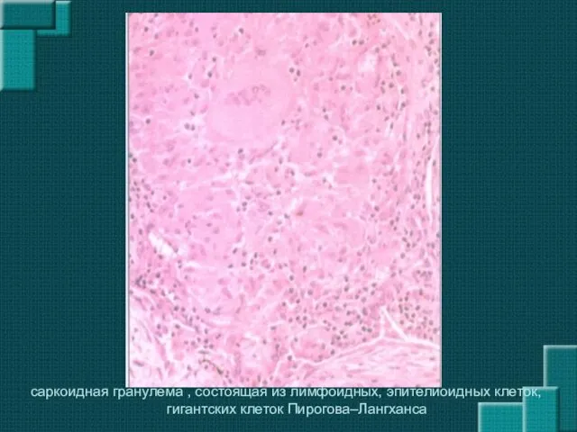 саркоидная гранулема , состоящая из лимфоидных, эпителиоидных клеток, гигантских клеток Пирогова–Лангханса