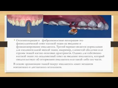 Оссеоинтеграция и фибрознокостная интеграция-это физиологической ответ костной ткани на введение и функционирование имплантата.