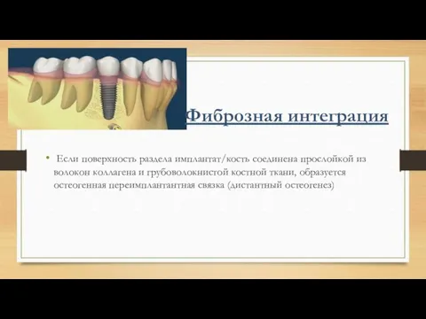 Если поверхность раздела имплантат/кость соединена прослойкой из волокон коллагена и грубоволокнистой костной ткани,