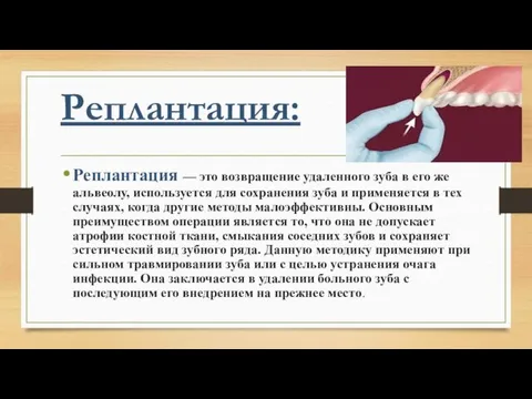 Реплантация: Реплантация — это возвращение удаленного зуба в его же альвеолу, используется для