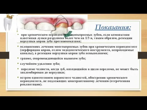 Показания: при хроническом периодонтите однокорневых зубов, если компактная пластинка лунки