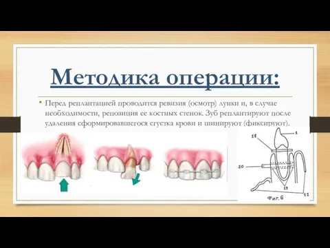 Методика операции: Перед реплантацией проводится ревизия (осмотр) лунки и, в случае необходимости, репозиция