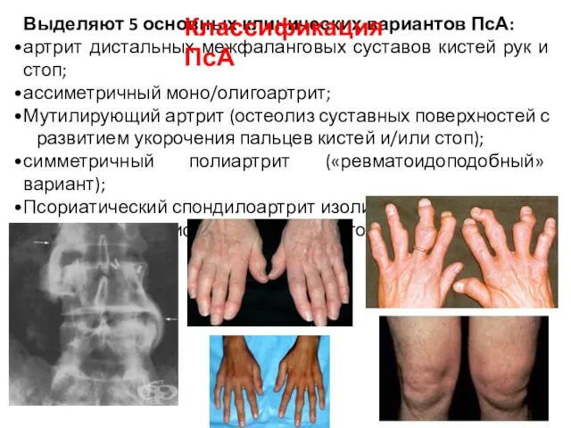 Выделяют 5 основных клинических вариантов ПсА: артрит дистальных межфаланговых суставов