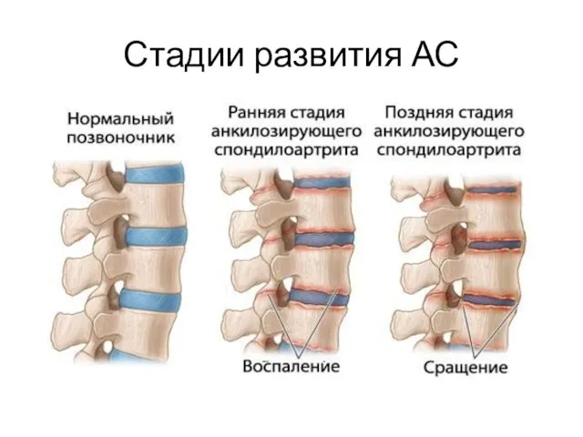 Стадии развития АС