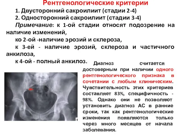 Рентгенологические критерии 1. Двусторонний сакроилиит (стадии 2-4) 2. Односторонний сакроилиит