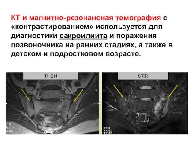 КТ и магнитно-резонансная томография с «контрастированием» используется для диагностики сакроилиита