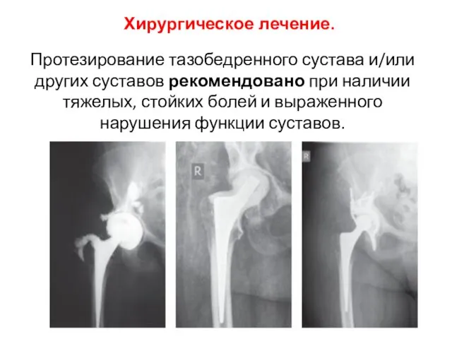 Хирургическое лечение. Протезирование тазобедренного сустава и/или других суставов рекомендовано при