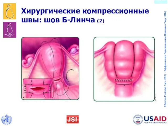 Хирургические компрессионные швы: шов Б-Линча (2)