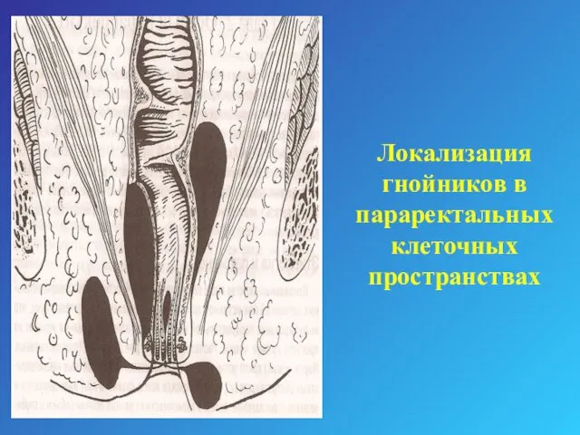 Локализация гнойников в параректальных клеточных пространствах