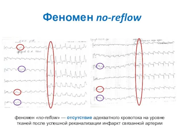 Феномен no-reflow феномен «no-reflow» — отсутствие адекватного кровотока на уровне