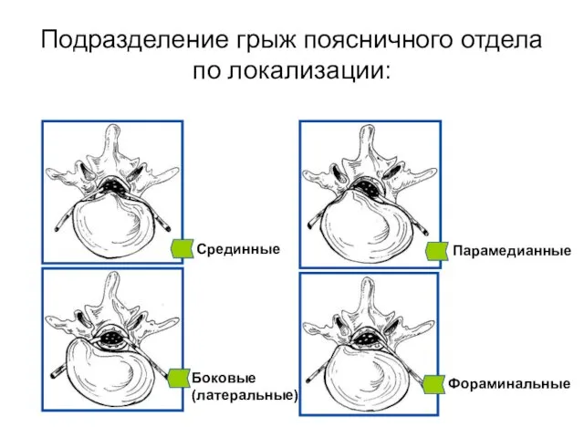 Подразделение грыж поясничного отдела по локализации: Срединные Парамедианные Боковые (латеральные) Фораминальные