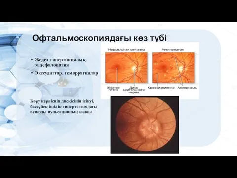 Офтальмоскопиядағы көз түбі Жедел гипертониялық энцефалопатия Экссудаттар, геморрагиялар Көру нервіснің