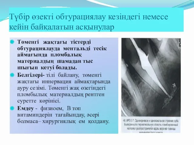 Түбір өзекті обтурациялау кезіндегі немесе кейін байқалатын асқынулар Төменгі жақтағы