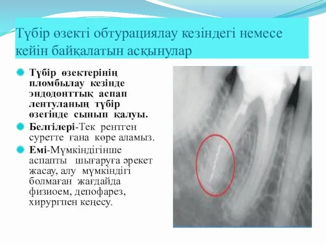 Түбір өзектерінің пломбылау кезінде эндодонттық аспап лентуланың түбір өзегінде сынып