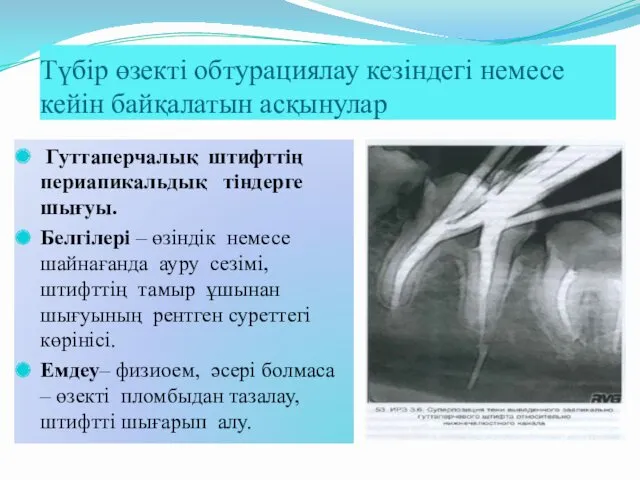 Түбір өзекті обтурациялау кезіндегі немесе кейін байқалатын асқынулар Гуттаперчалық штифттің