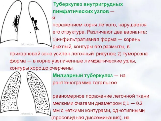 Туберкулез внутригрудных лимфатических узлов — характеризуется поражением корня легкого, нарушается