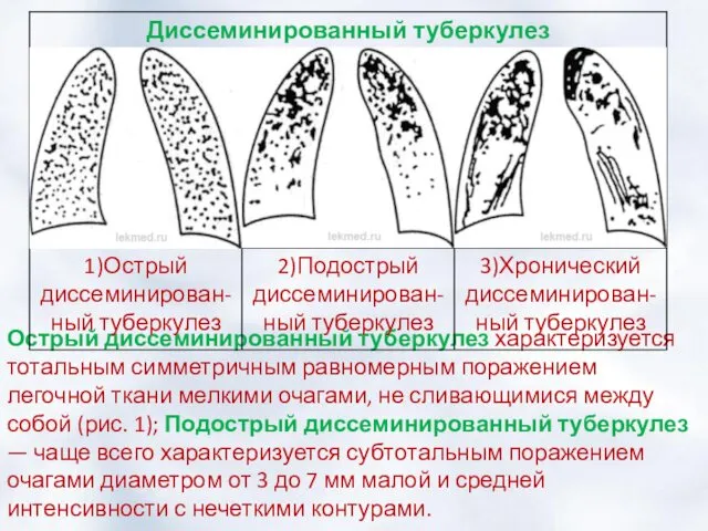 Острый диссеминированный туберкулез характеризуется тотальным симметричным равномерным поражением легочной ткани