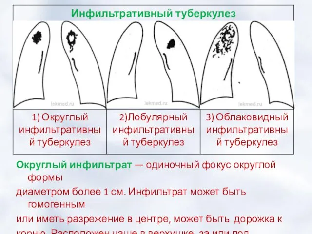 Округлый инфильтрат — одиночный фокус округлой формы диаметром более 1