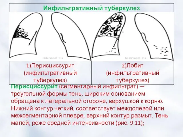 Перисциссурит (сегментарный инфильтрат) — треугольной формы тень, широким основанием обращена