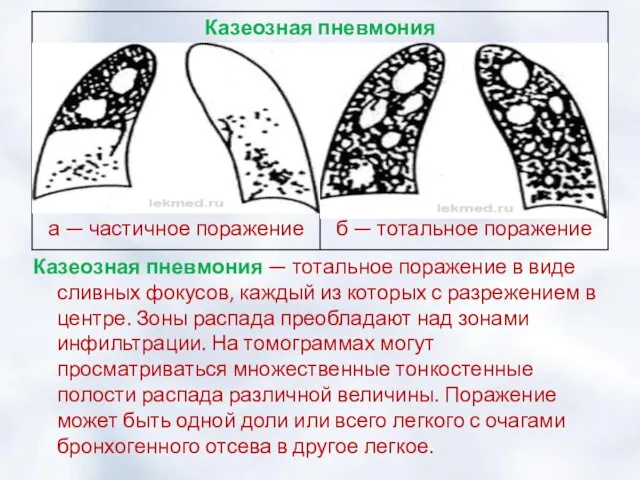 Казеозная пневмония — тотальное поражение в виде сливных фокусов, каждый