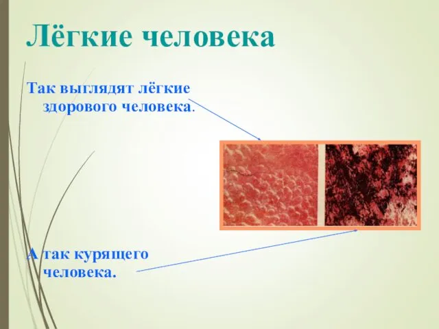 Лёгкие человека Так выглядят лёгкие здорового человека. А так курящего человека.