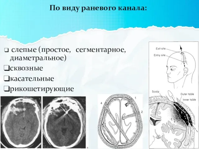 По виду раневого канала: слепые (простое, сегментарное, диаметральное) сквозные касательные рикошетирующие