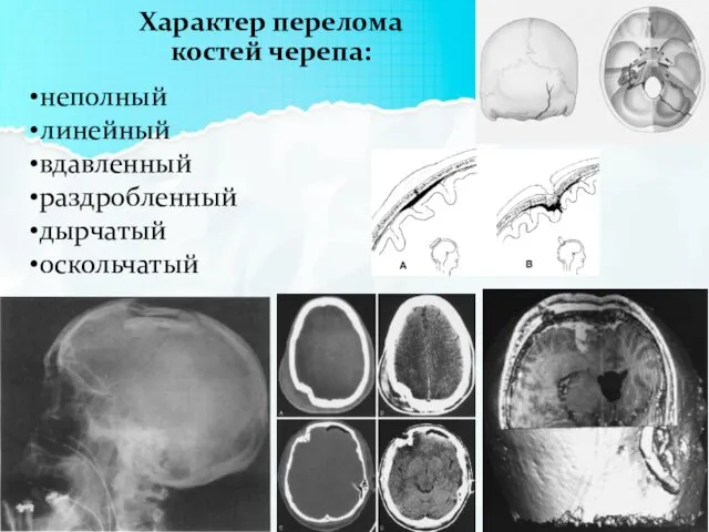 неполный линейный вдавленный раздробленный дырчатый оскольчатый Характер перелома костей черепа: