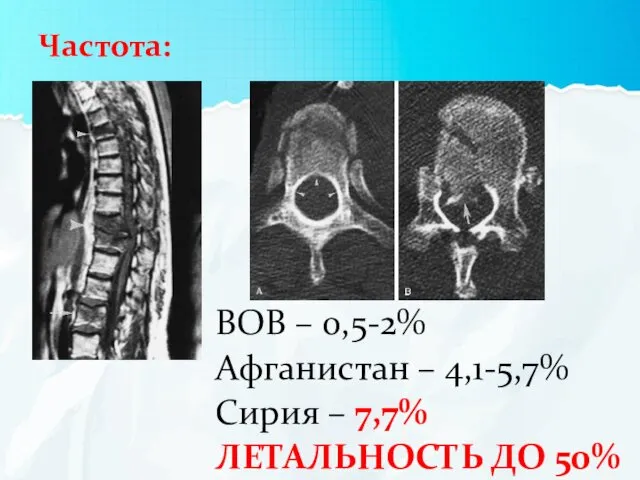 Частота: ВОВ – 0,5-2% Афганистан – 4,1-5,7% Сирия – 7,7% ЛЕТАЛЬНОСТЬ ДО 50%