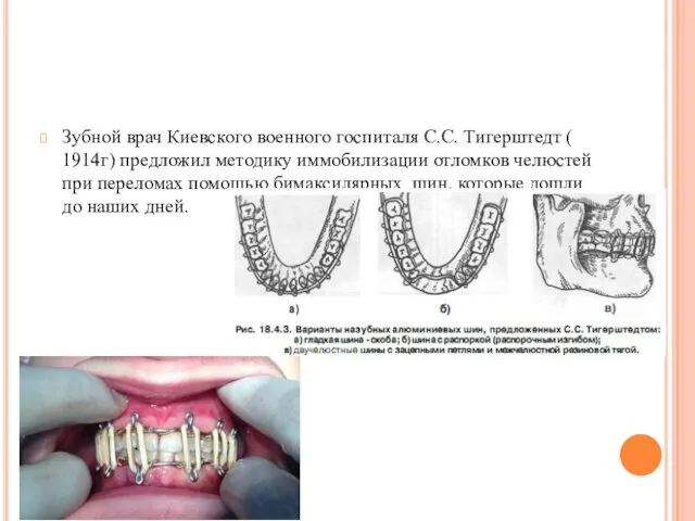 Зубной врач Киевского военного госпиталя С.С. Тигерштедт ( 1914г) предложил методику иммобилизации отломков