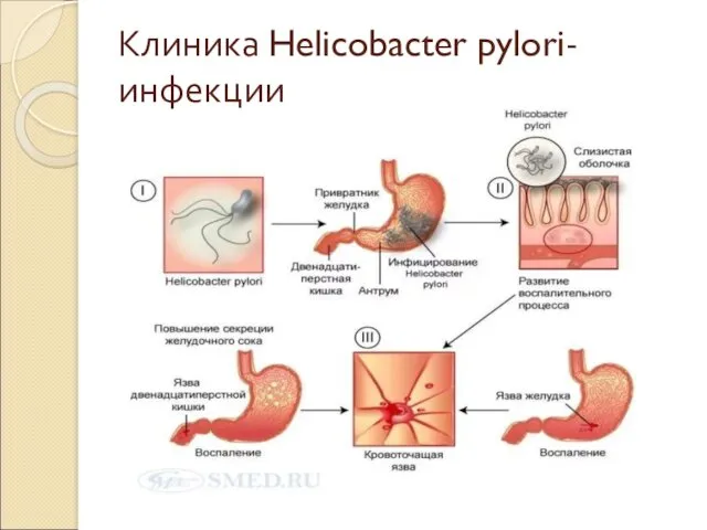 Клиника Helicobacter pylori-инфекции