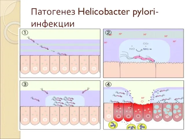 Патогенез Helicobacter pylori-инфекции