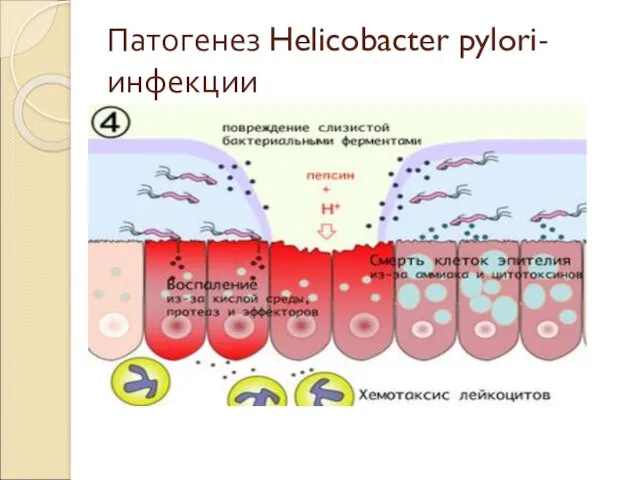 Патогенез Helicobacter pylori-инфекции