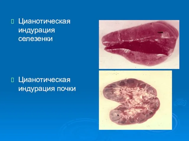 Цианотическая индурация селезенки Цианотическая индурация почки