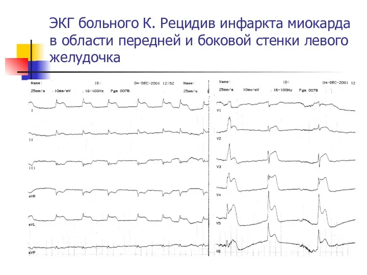 ЭКГ больного К. Рецидив инфаркта миокарда в области передней и боковой стенки левого желудочка