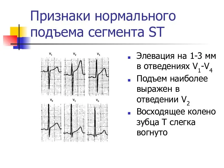 Элевация на 1-3 мм в отведениях V1-V4 Подъем наиболее выражен