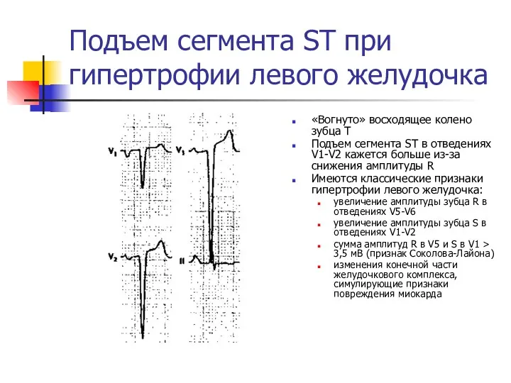 Подъем сегмента ST при гипертрофии левого желудочка «Вогнуто» восходящее колено