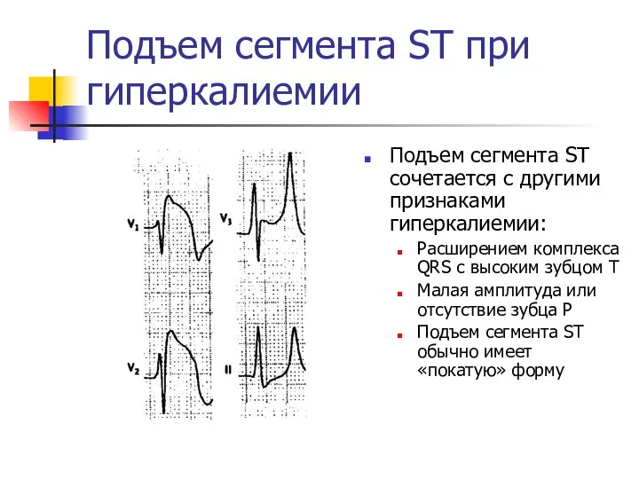 Подъем сегмента ST при гиперкалиемии Подъем сегмента ST сочетается с