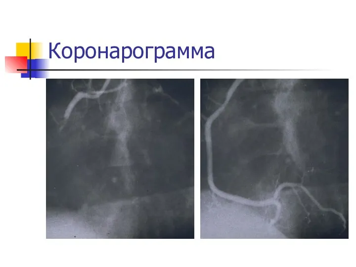 Коронарограмма