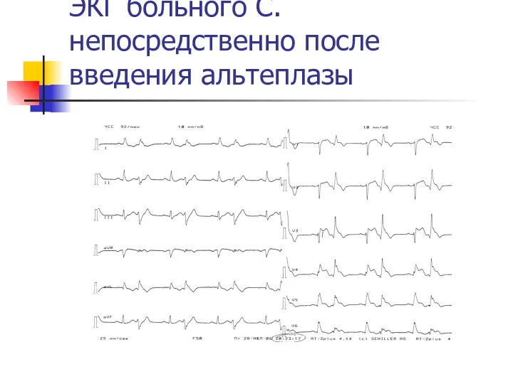 ЭКГ больного С. непосредственно после введения альтеплазы