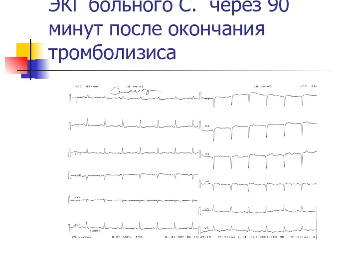 ЭКГ больного С. через 90 минут после окончания тромболизиса