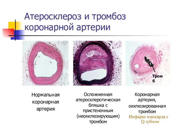 Атеросклероз и тромбоз коронарной артерии