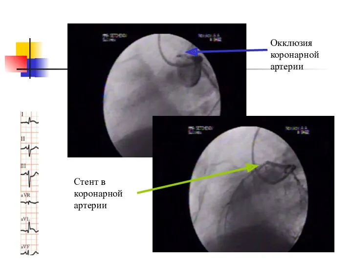 Окклюзия коронарной артерии Стент в коронарной артерии